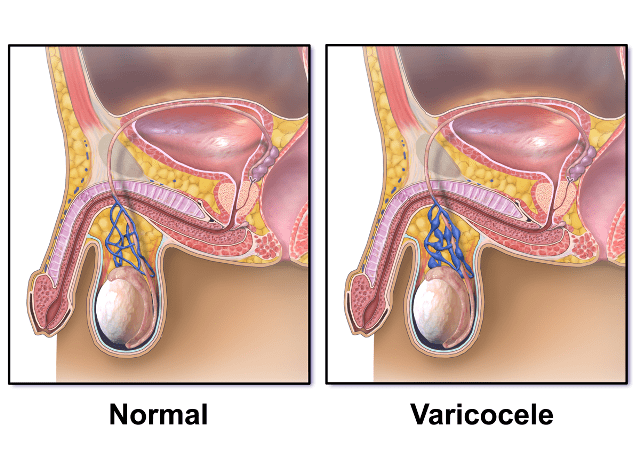 Varicocele- Leading Cause of Infertility